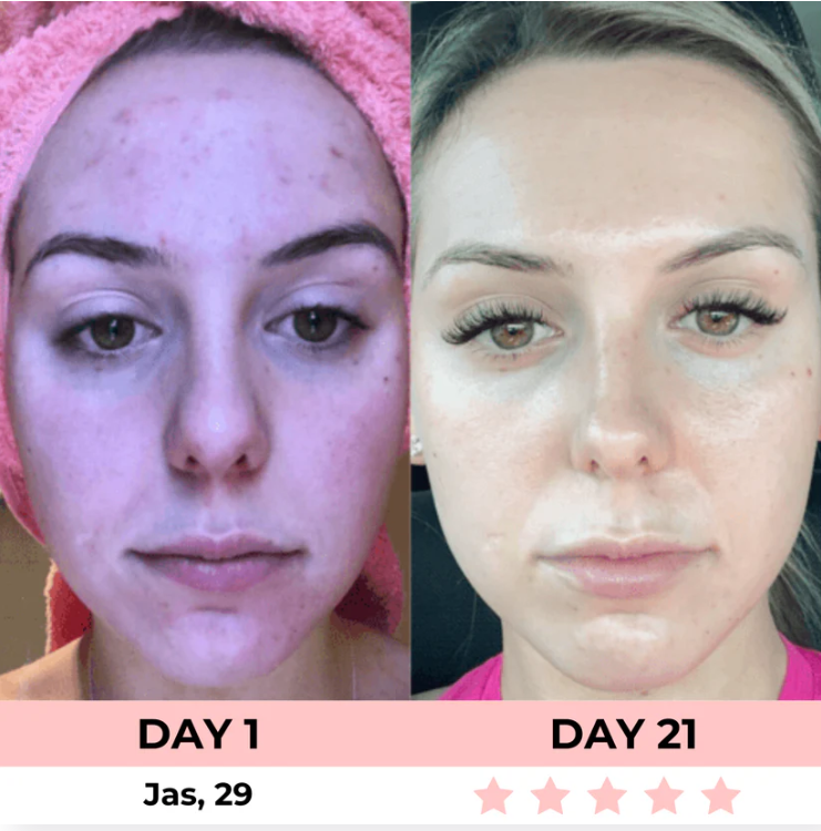 Lumelift Pro 3-in-1 LED Facial Sculptor